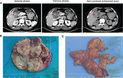 Case Report: SMARCA4 (BRG1)-deficient undifferentiated carcinoma of gallbladder with genetic analysis